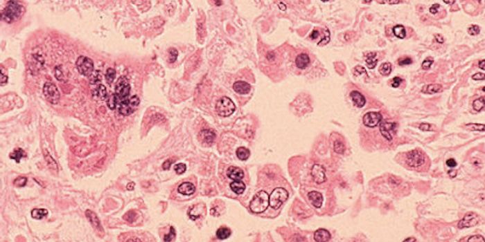 Unvaccinated Children at Risk of Measles, Stress Scientists