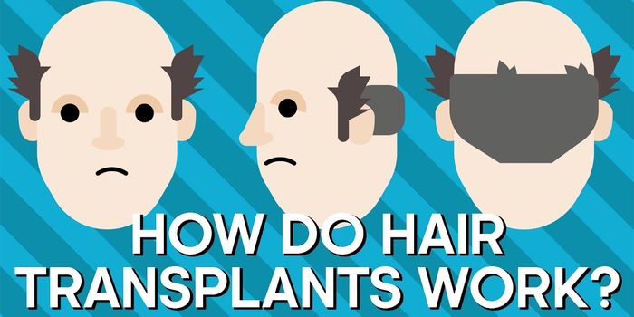 How Does Hair Transplant Work?