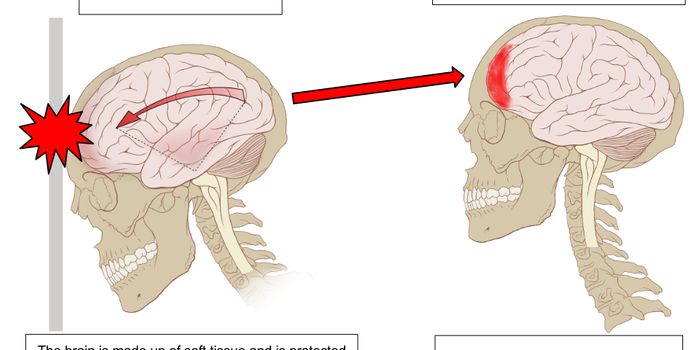 96% Of NFL Players Examined Have Brain Injuries