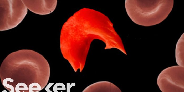 Sickle Cell Anemia - a Genetic Disorder