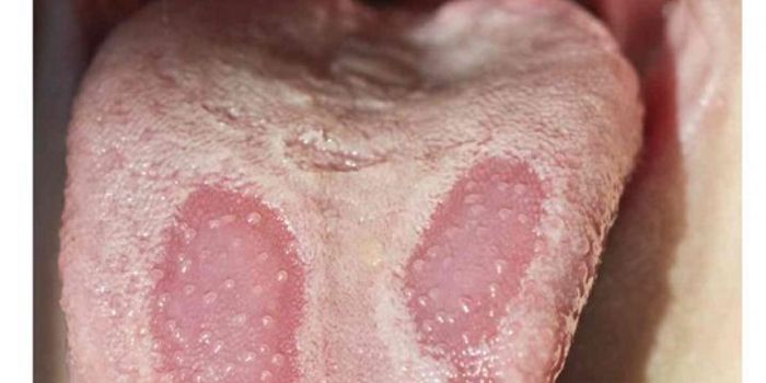 Mechanics of Mysterious Map-Design Tongue Condition