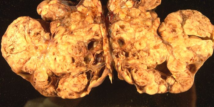 Getting the Last of Cancer Out