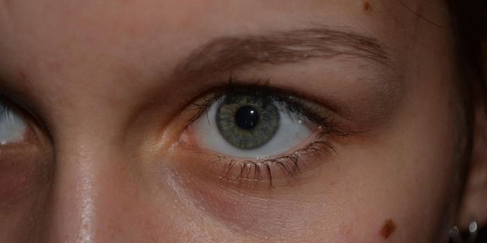 Melanocytic Nevi and their Association with Melanoma