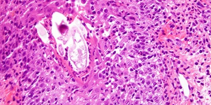 Genetic Links to Rosacea, Study Finds