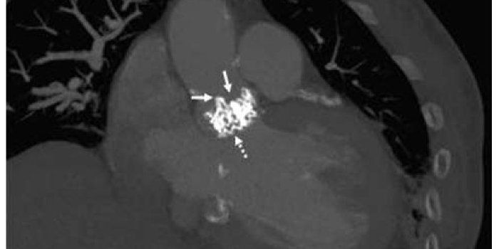 Bioprosthetic Valves Safer than Mechanical Valves for Aortic Valve Replacement Procedures