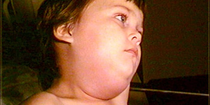 Washington's Mumps Outbreak Tops 400 Cases