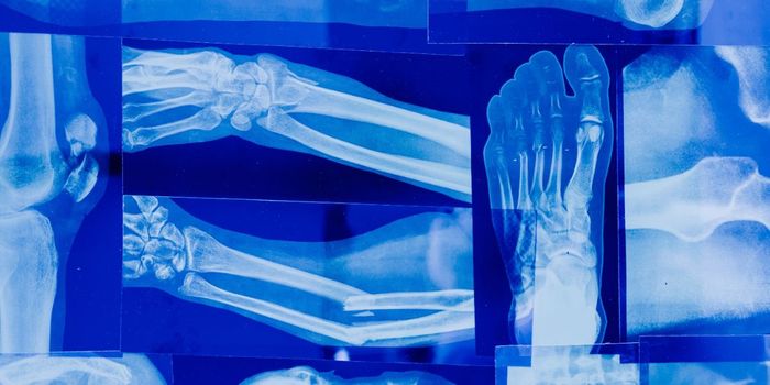 Antibiotics for Acne May Impair Bone Development in Teens