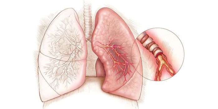 An Antibody Proven Effective in Treating Severe Asthma