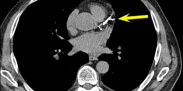 CT Scan Slightly Edges Out Functional Tests for Heart Disease
