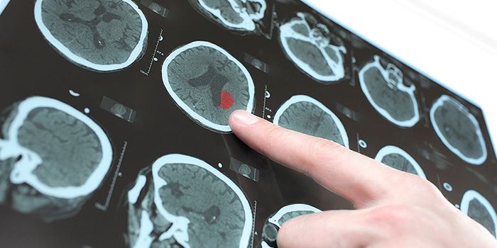 Treating "Wake-Up Stroke" With Tissue Plasminogen Activators