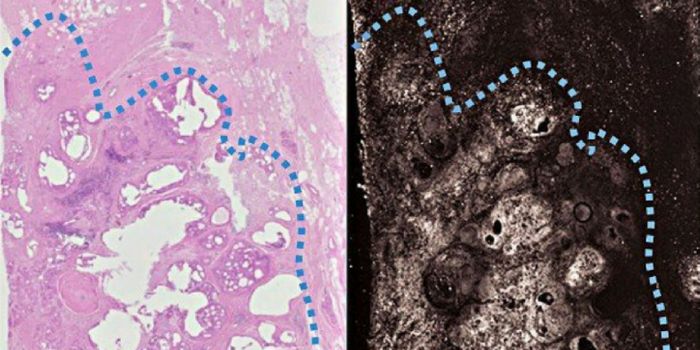 Technique Ensures Surgeons Remove All of the Tumor in One Go