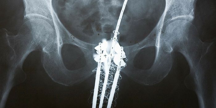 Trial Showed Safety and Effectiveness of Brachytherapy Against Cervical Cancer