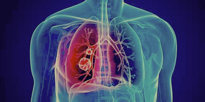 Sugar Molecule Demonstrated to Halt Emphysema Progression