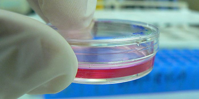 Research of Rare Genetic Disease Yields Insight Into Stem Cells