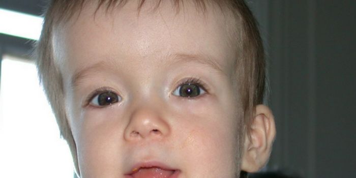 Measurements Matter in Craniosynostosis