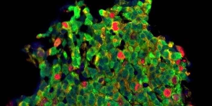 New Class of Drugs Beats Lethal Prostate Cancer Resistance