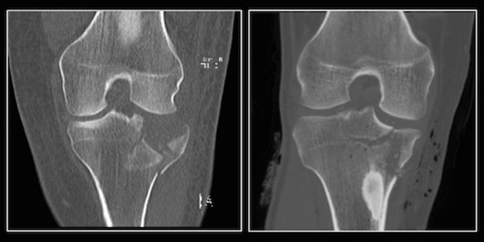 CT Scan Detects Fractures Using 14-Times Less Radiation
