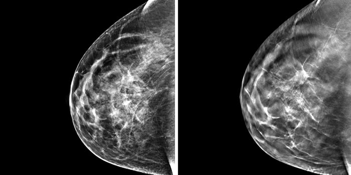 Should Healthy Women Take Breast Cancer Drugs?