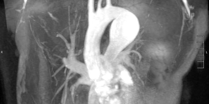 June Edition of Vascular Medicine Dedicated to Aortic Diseases