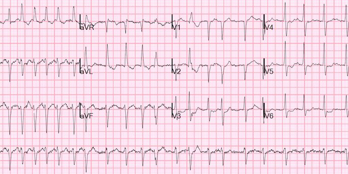 Surgeons Highly Recommend This Surgery for Atrial Fibrillation