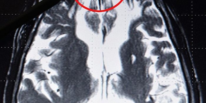 'Moral' Brain May Get Switched Off in Killers