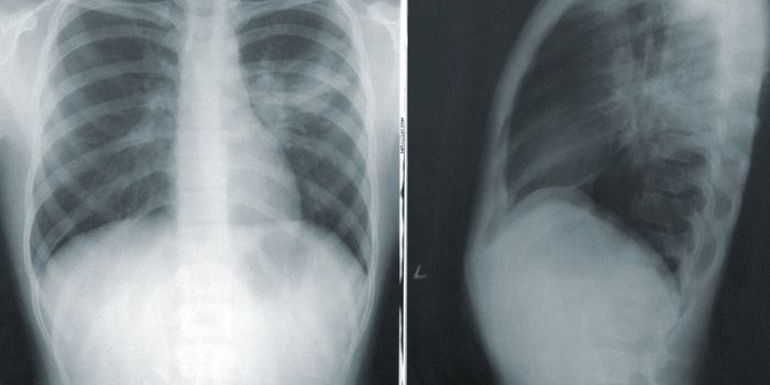 Antifungal Drug May Treat Cystic Fibrosis