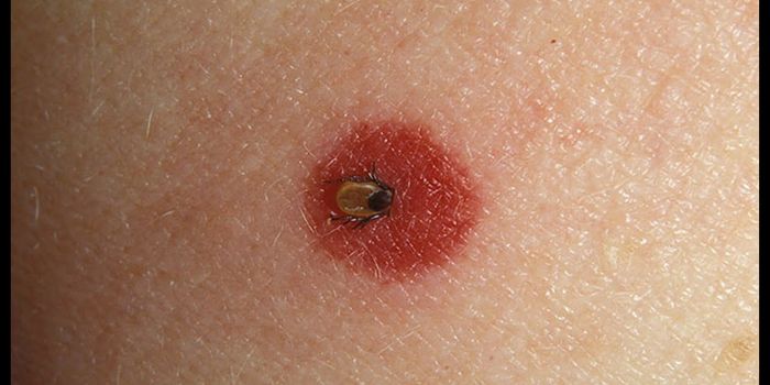 Understanding How Lyme Disease Persists in the Body