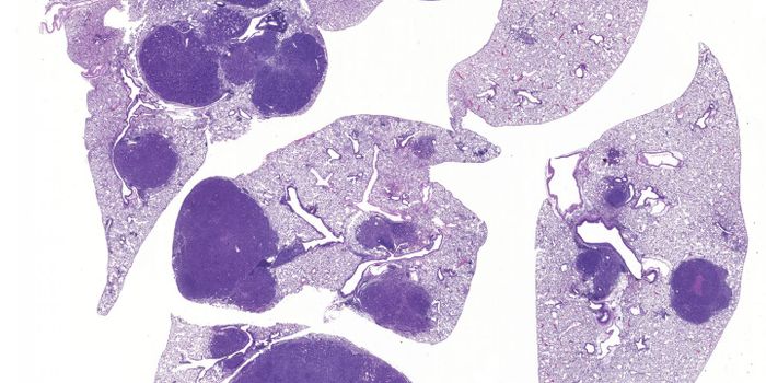 New Drug Targets for Lung Cancer Identified