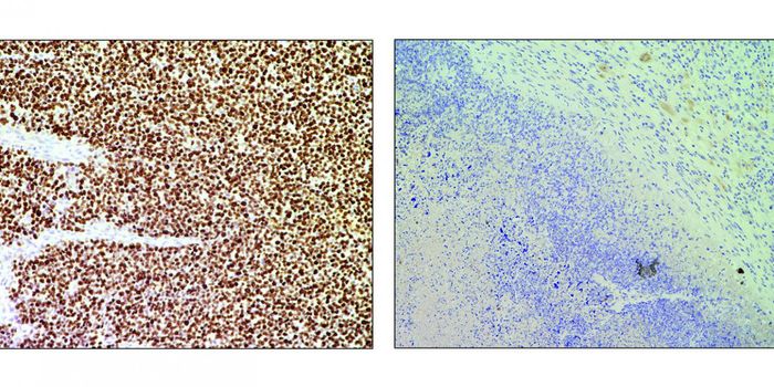 Using CRISPR to Destroy Cancer Cells