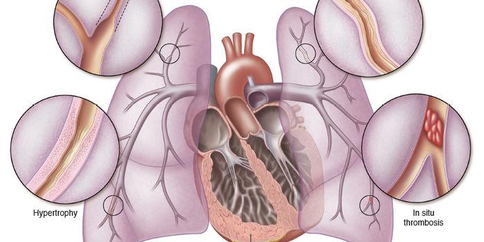 New Controlled Release Microspheres Treatment for Pulmonary Arterial Hypertenstion Patients
