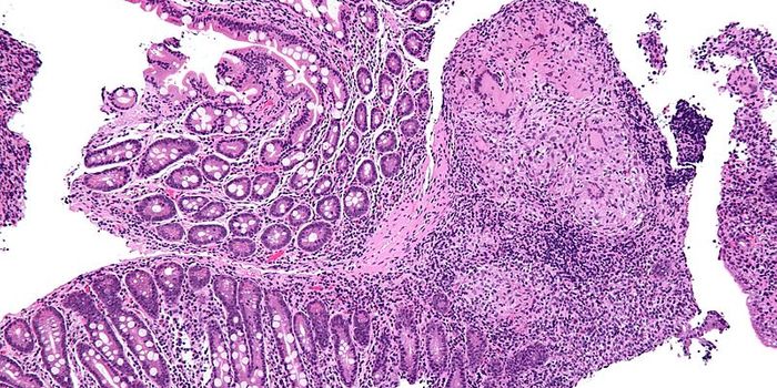 Circulating Immune Cells Accidentally Promote Crohn's Disease