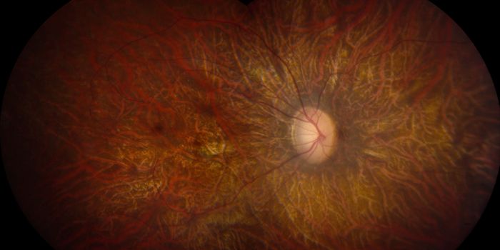 3 Patients Lose Sight After Stem Cell Injections