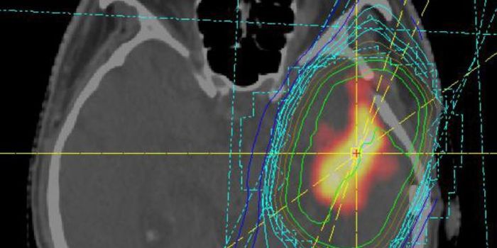 MicroRNAs Predict Disease Progression in Brain Tumors