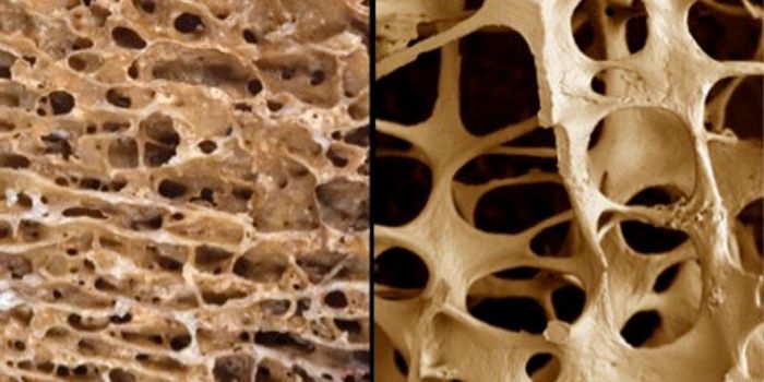 For Some Osteoporosis, Taking Medications May Be a Mistake