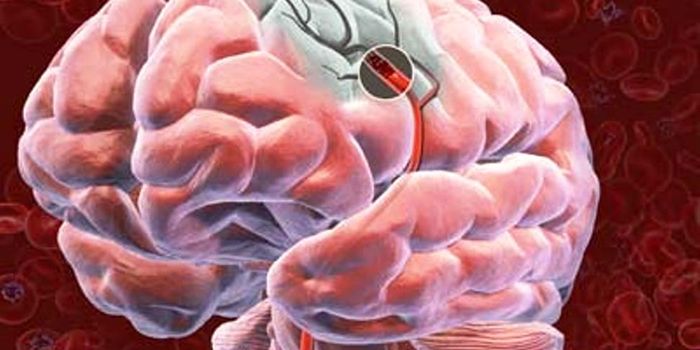 Removing Blood Clots More Than Six Hours After Stroke is Still Effective