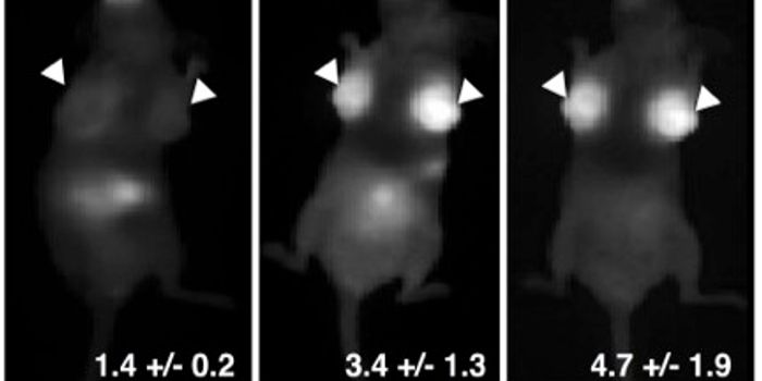 Pill Lights Up Breast Cancer Lumps for Easier Detection