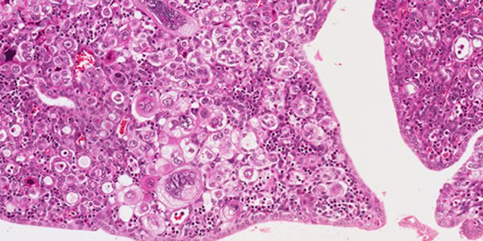 Personal Profiling for Womb Cancer