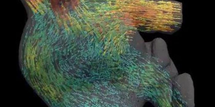 Predicting Your Risk of Stroke With the Shape of Blood Flow