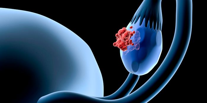 Immunotherapy Target Identified For Ovarian Cancer Treatment