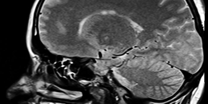 Metal beads that could help reduce chemotherapy side effects in brain tumor