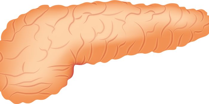 An Arthritis Drug Combats Chemoresistance in Pancreatic Cancer