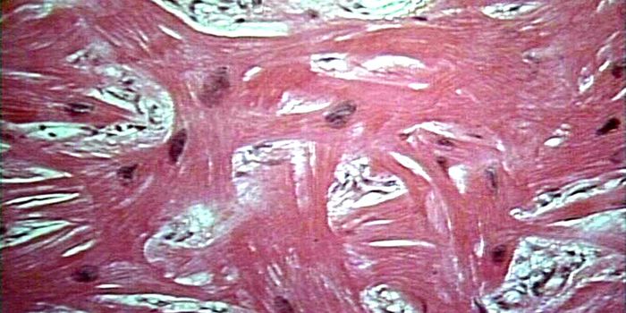 A Stem Cell Model of Hypertrophic Cardiomyopathy