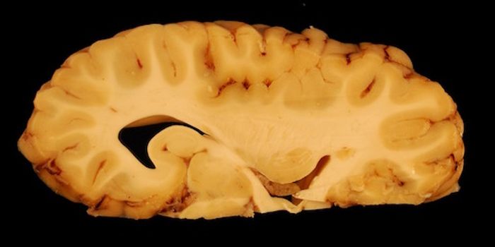 Potential Drug Candidate for Autism, Alzheimer's is ID'ed