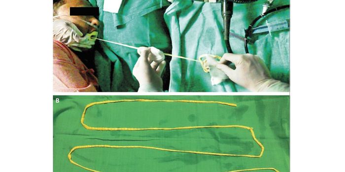 Doctors Pull 6ft Tapeworm from Man's Mouth