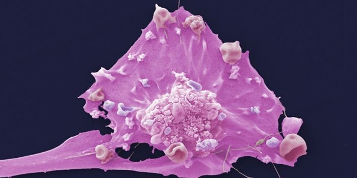 Breast Cancer Cells May Spread by Mimicking Blood Vessels