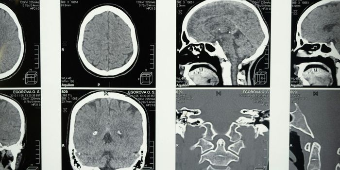 Intranasal Nanotherapy Shows Promise Against Glioblastomas