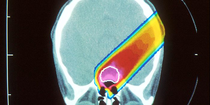 Proton Therapy May Reduce Second Cancer Risk More Than Other Radiation Types