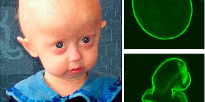 New Drug Candidate to Reverse Progeria Aging Symptoms in Cells