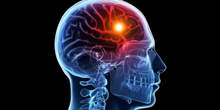 Be Aware! Strokes Can Happen to Anyone