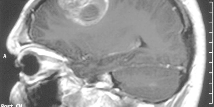 Brain Tumors: How Surgeons are Operating on the Inoperable